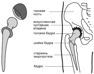 Артроз. Самые эффективные методы лечения