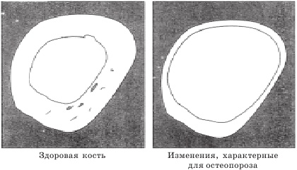 Остеопороз. Тихая эпидемия XXI века