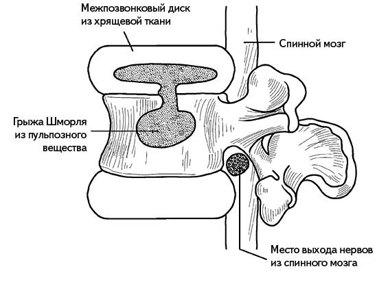 Жизнь без боли в спине. Лечение сколиоза, остеопороза, остеохондроза, межпозвонковой грыжи без операции