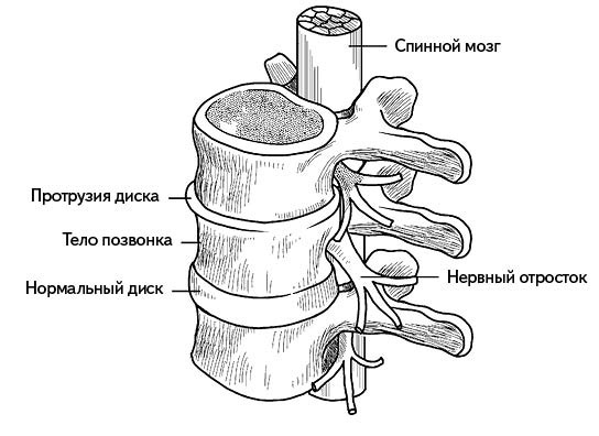 Жизнь без боли в спине. Лечение сколиоза, остеопороза, остеохондроза, межпозвонковой грыжи без операции