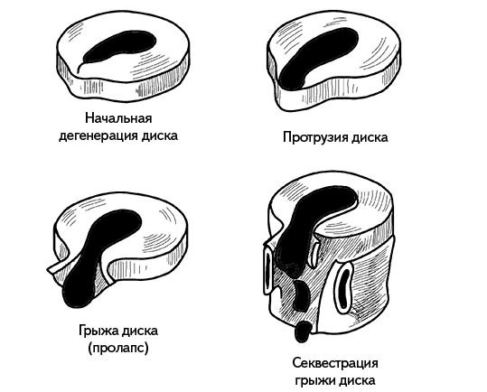 Жизнь без боли в спине. Лечение сколиоза, остеопороза, остеохондроза, межпозвонковой грыжи без операции