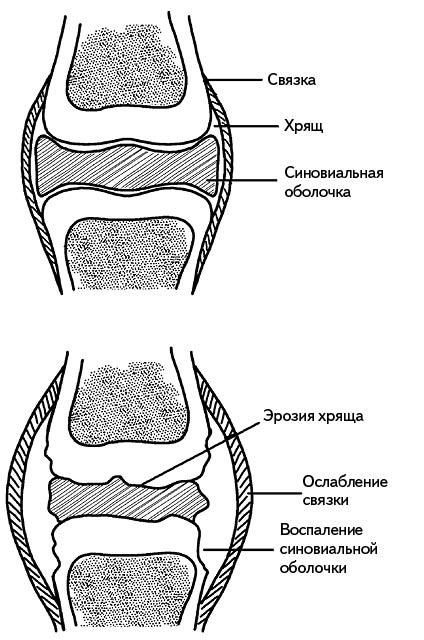 Жизнь без боли в спине. Лечение сколиоза, остеопороза, остеохондроза, межпозвонковой грыжи без операции