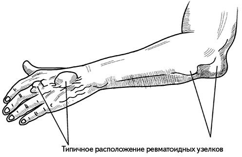 Жизнь без боли в спине. Лечение сколиоза, остеопороза, остеохондроза, межпозвонковой грыжи без операции