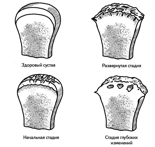 Жизнь без боли в спине. Лечение сколиоза, остеопороза, остеохондроза, межпозвонковой грыжи без операции