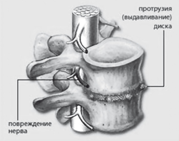 Лучшие методы лечения остеохондроза