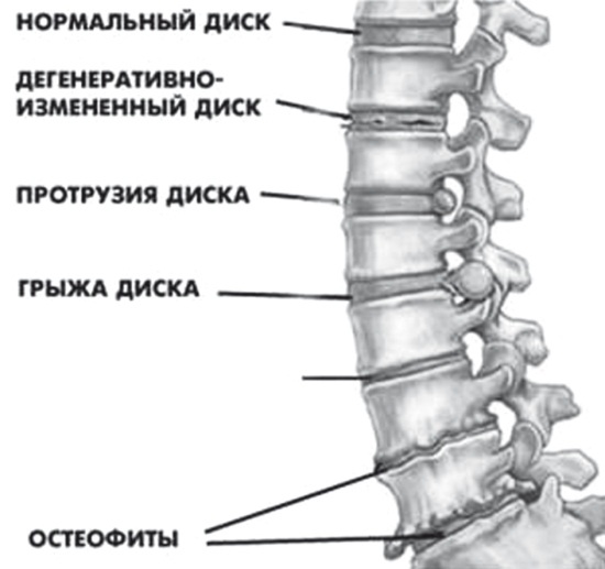 Лучшие методы лечения остеохондроза