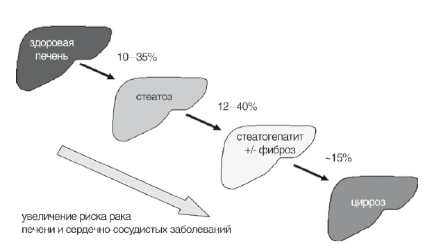 Неалкогольная жировая болезнь печени