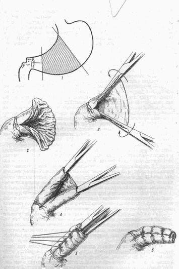 Этюды желудочной хирургии