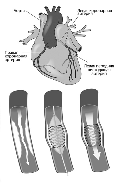 Мифы и заблуждения о сердце и сосудах