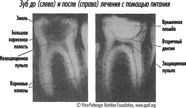 Естественное лечение кариеса. Реминерализация и восстановление зубов при помощи питания